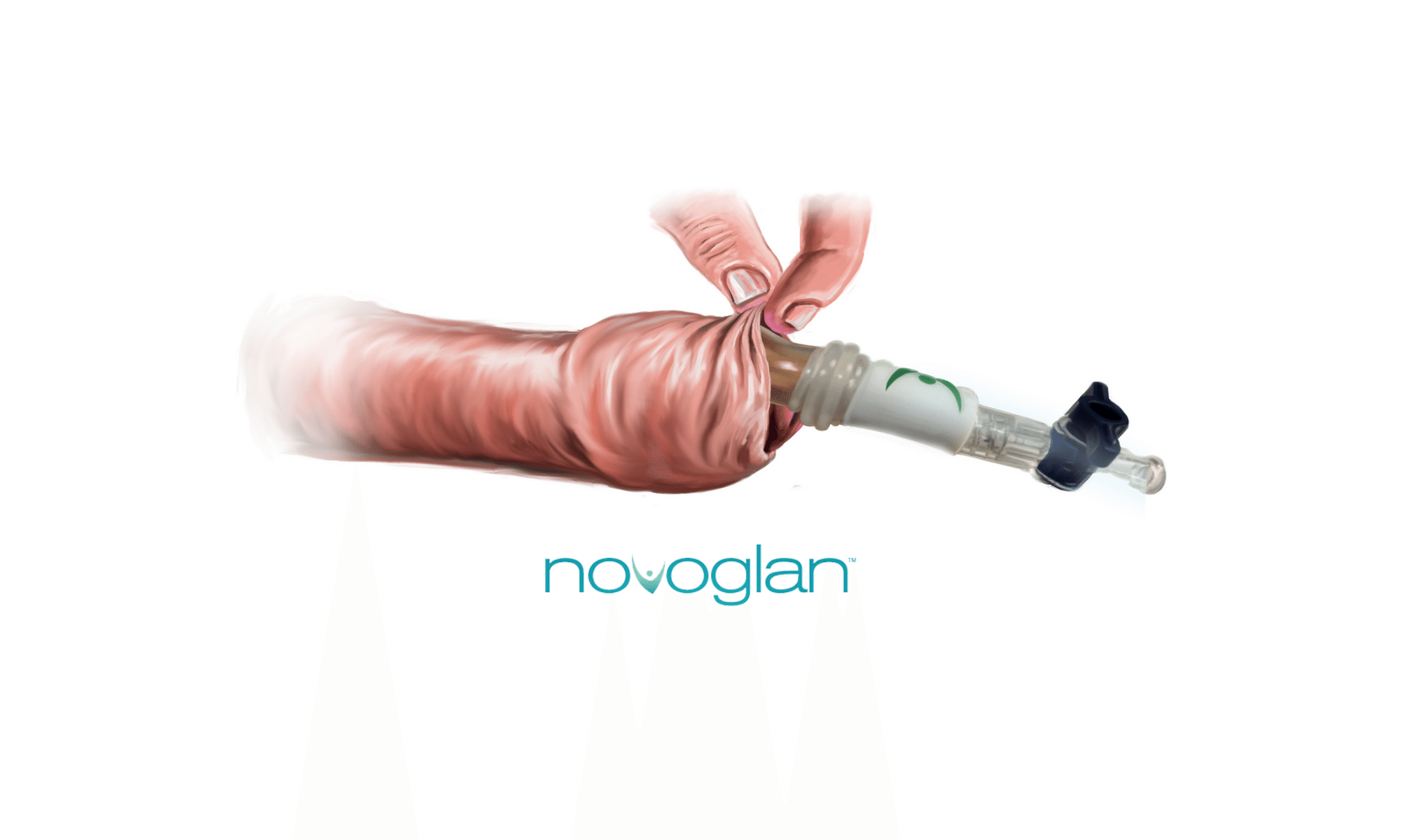 Novoglan Phimosis Treatment in UK