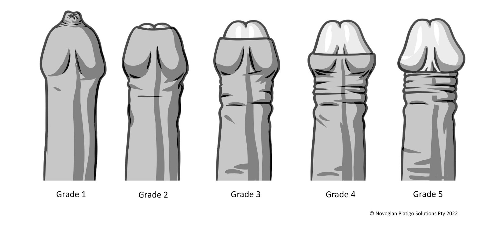 What Are The Different Grades Of Phimosis?